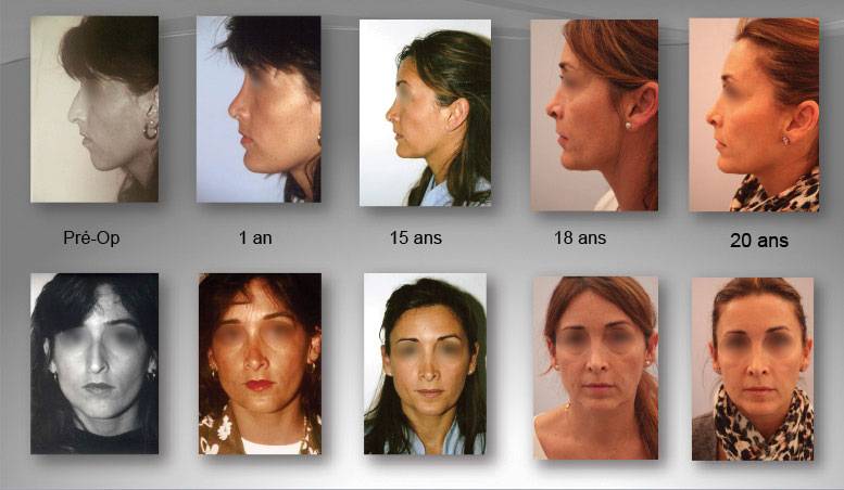 Chrirurgie du profil par le Dr R.Casey de Cannes et évolution du visage sur 20 ans
