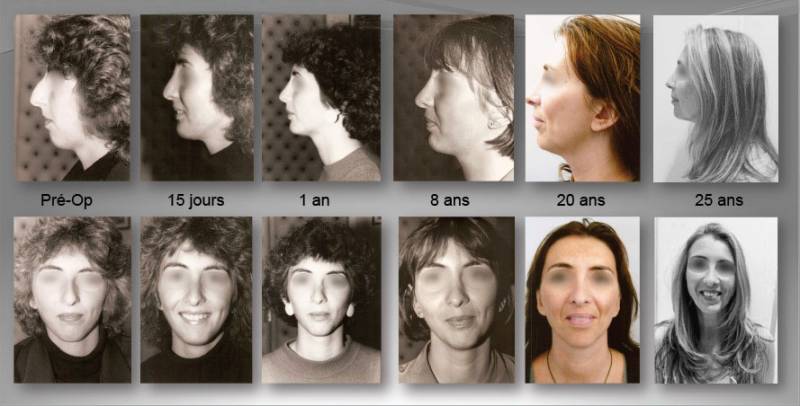 Interventions chirurgicales sur le nez et le menton par le Dr R.Casey de Cannes et évolution du visage sur 25 ans.